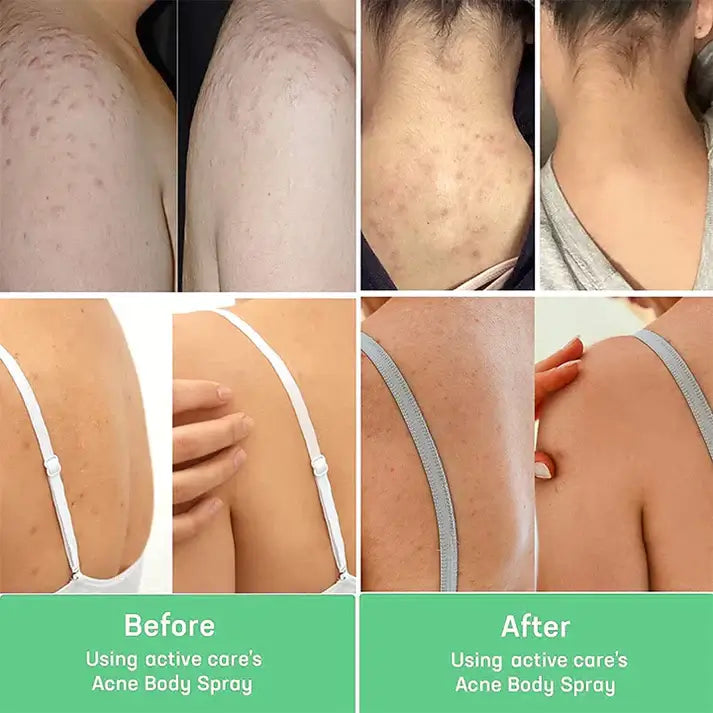 Instant Back Acne Remover